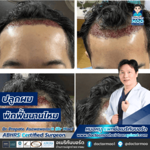 ปลูกผม พักฟื้นนานไหม