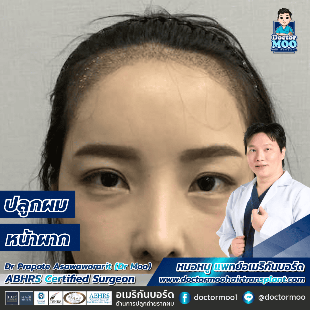 ไรผม หน้าผาก