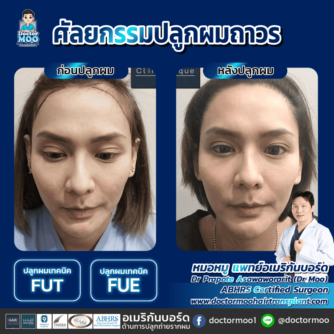 hair transplant คือ