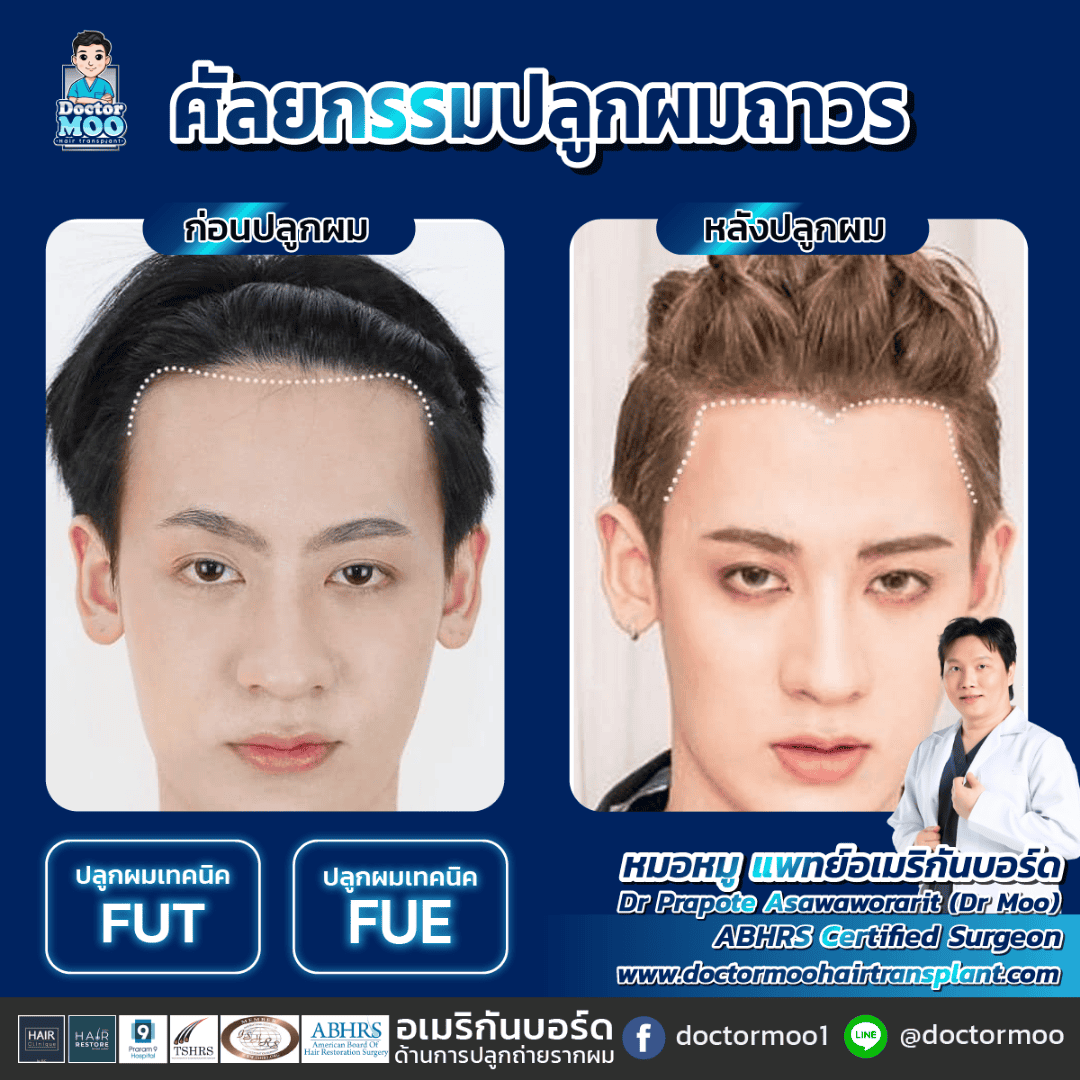 ปลูกผมไม่ขึ้น