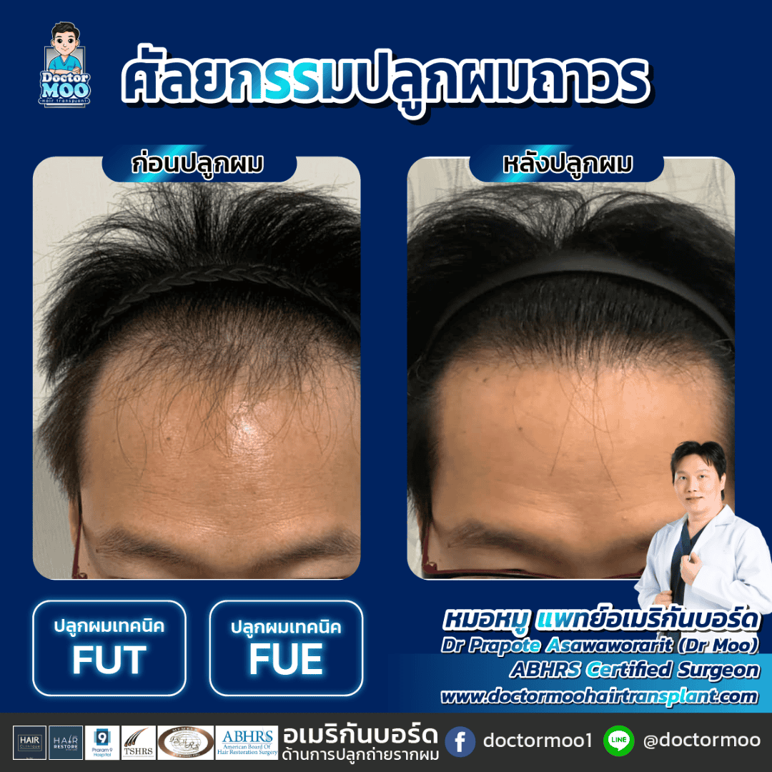 ปลูกผมแบบย้ายรากผม