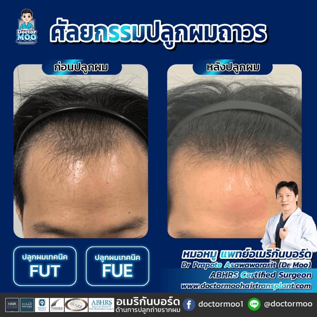 ปลูกผมแบบย้ายรากผม
