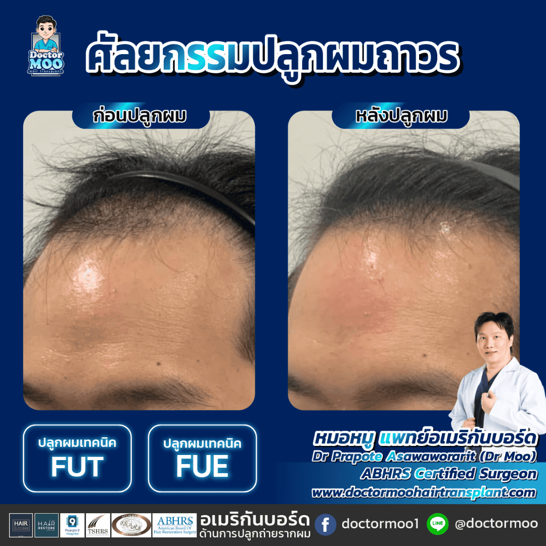 ปลูกผมแบบย้ายรากผม