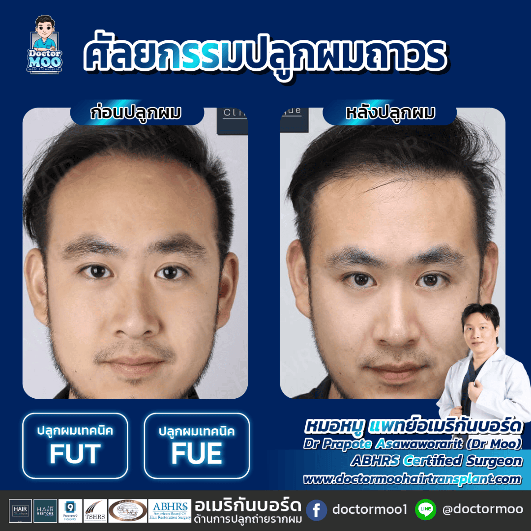 ปลูกผมไม่ต้องโกน