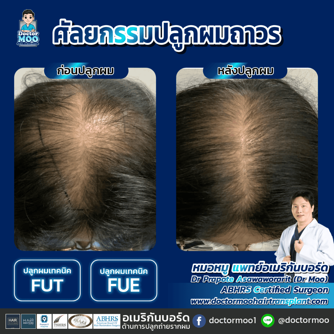ปลูกผมแบบย้ายรากผม