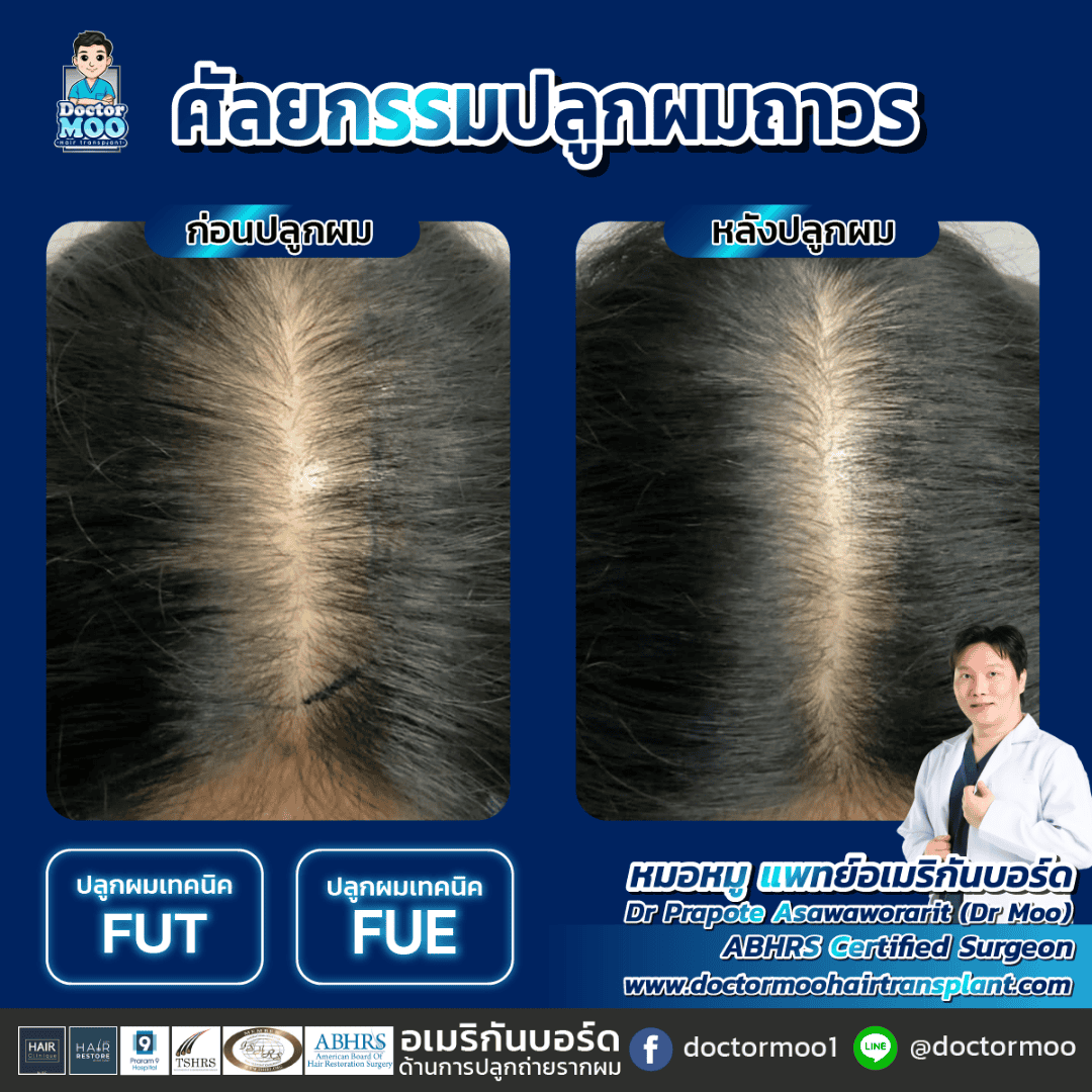 ปลูกผมแบบย้ายรากผม