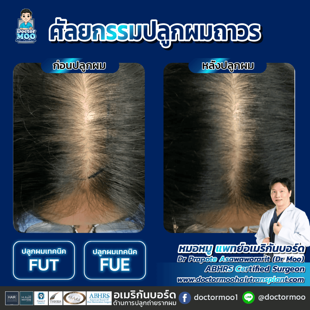 กราฟปลูกผม คืออะไร