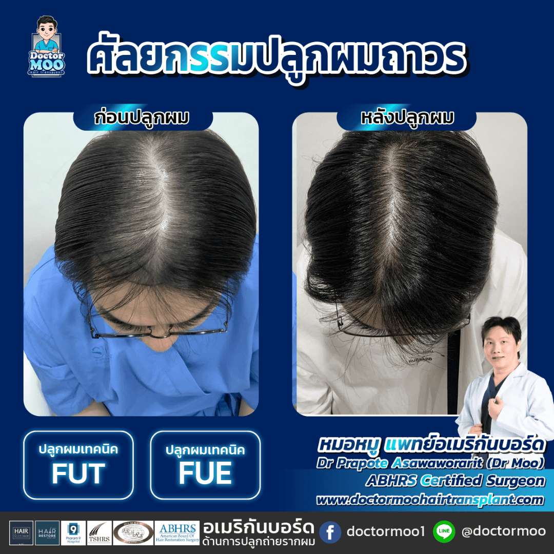 ปลูกผมแบบย้ายรากผม