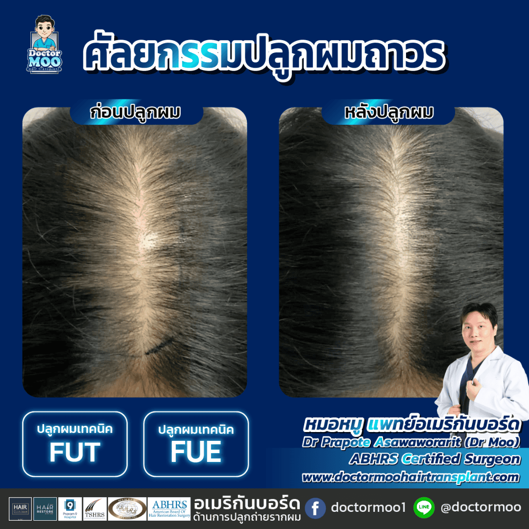 กราฟปลูกผม คืออะไร