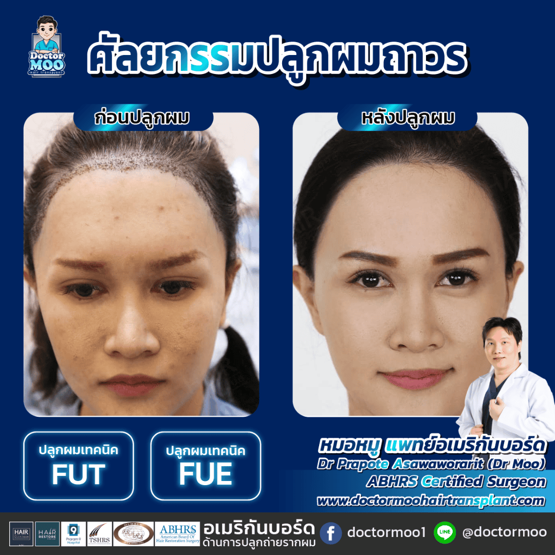 ปลูกผม แก้ปัญหาหน้าผากกว้าง ปลูกผม แก้ปัญหาหน้าผากกว้าง