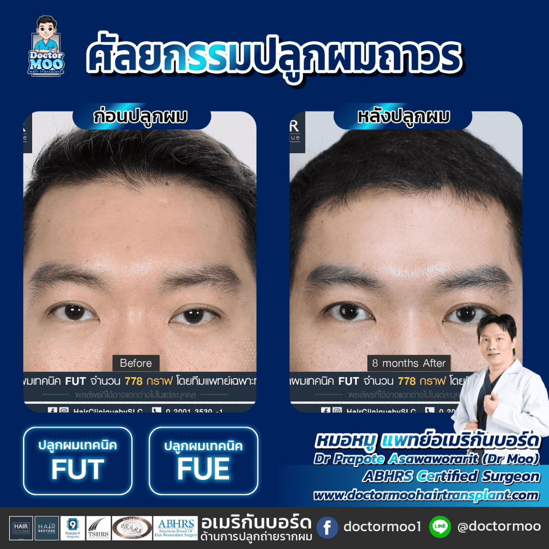 ปลูกผมไม่ต้องโกน