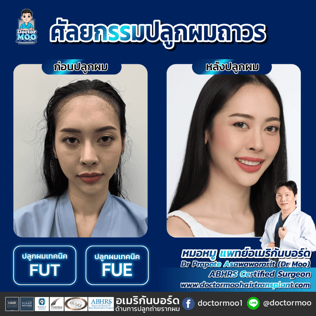 ปลูกผมผู้หญิง ผมร่วงจากกรรมพันธุ์