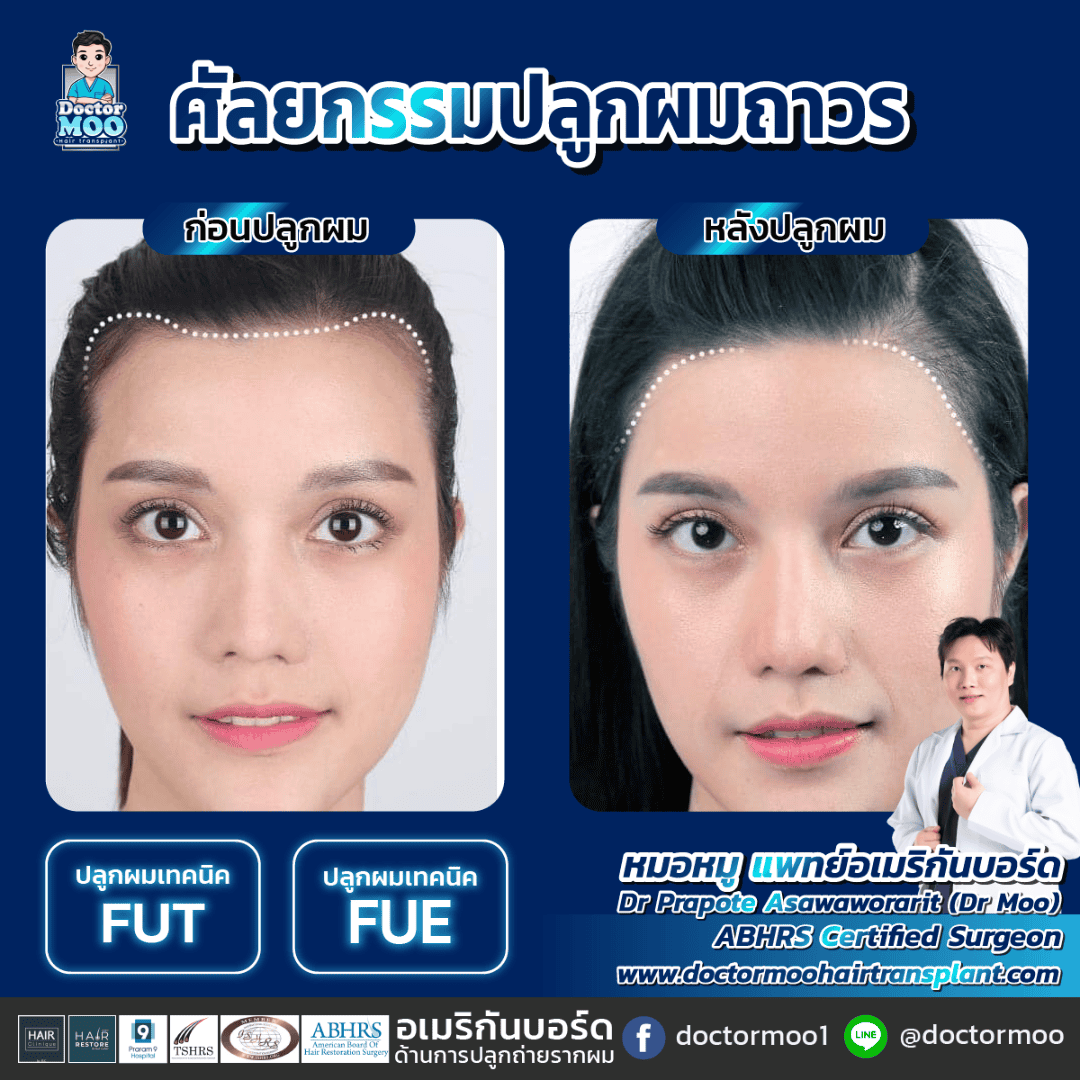 ปลูกผมด้านหน้า