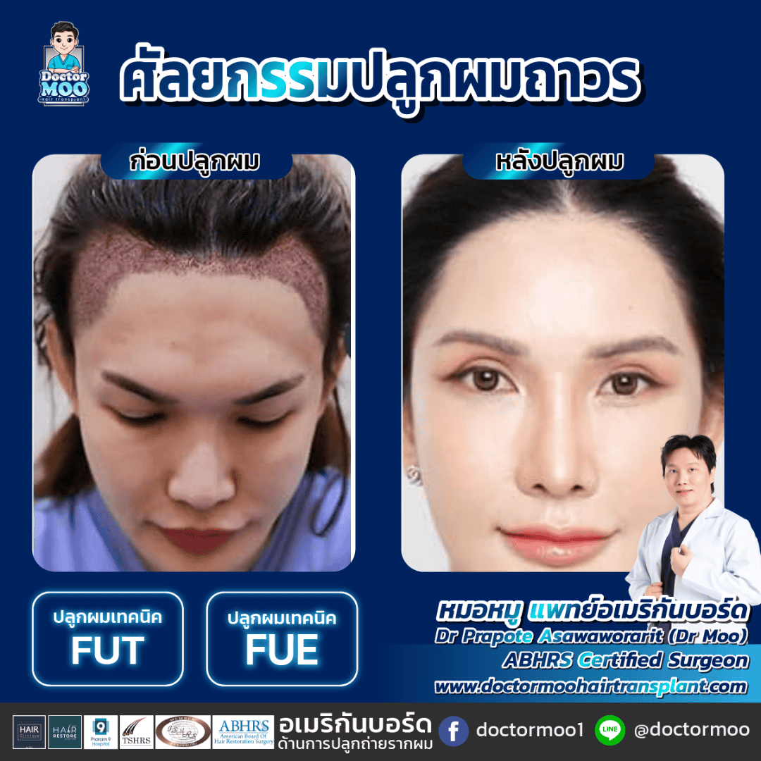 ปลูกผม แก้ปัญหาหน้าผากกว้าง ปลูกผม ปรับโหงวเฮ้งหน้าผาก ผู้หญิง