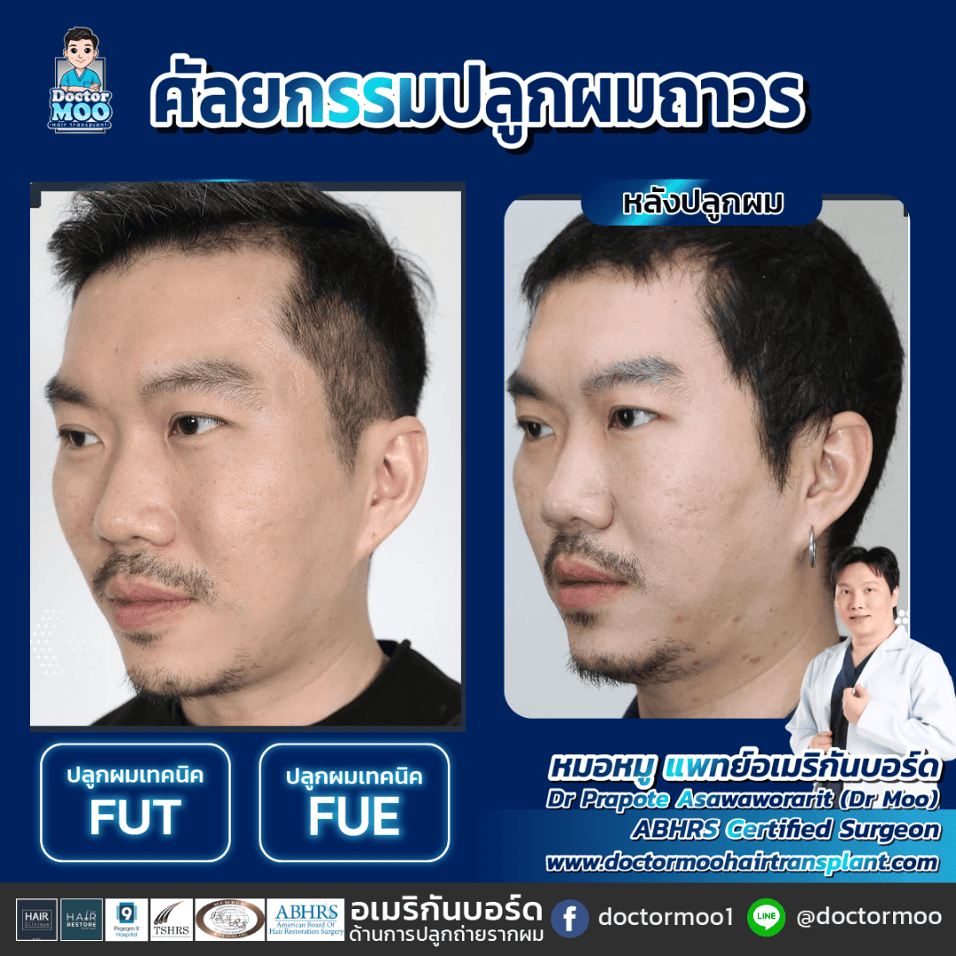 ปลูกผม FUE กับ FUT