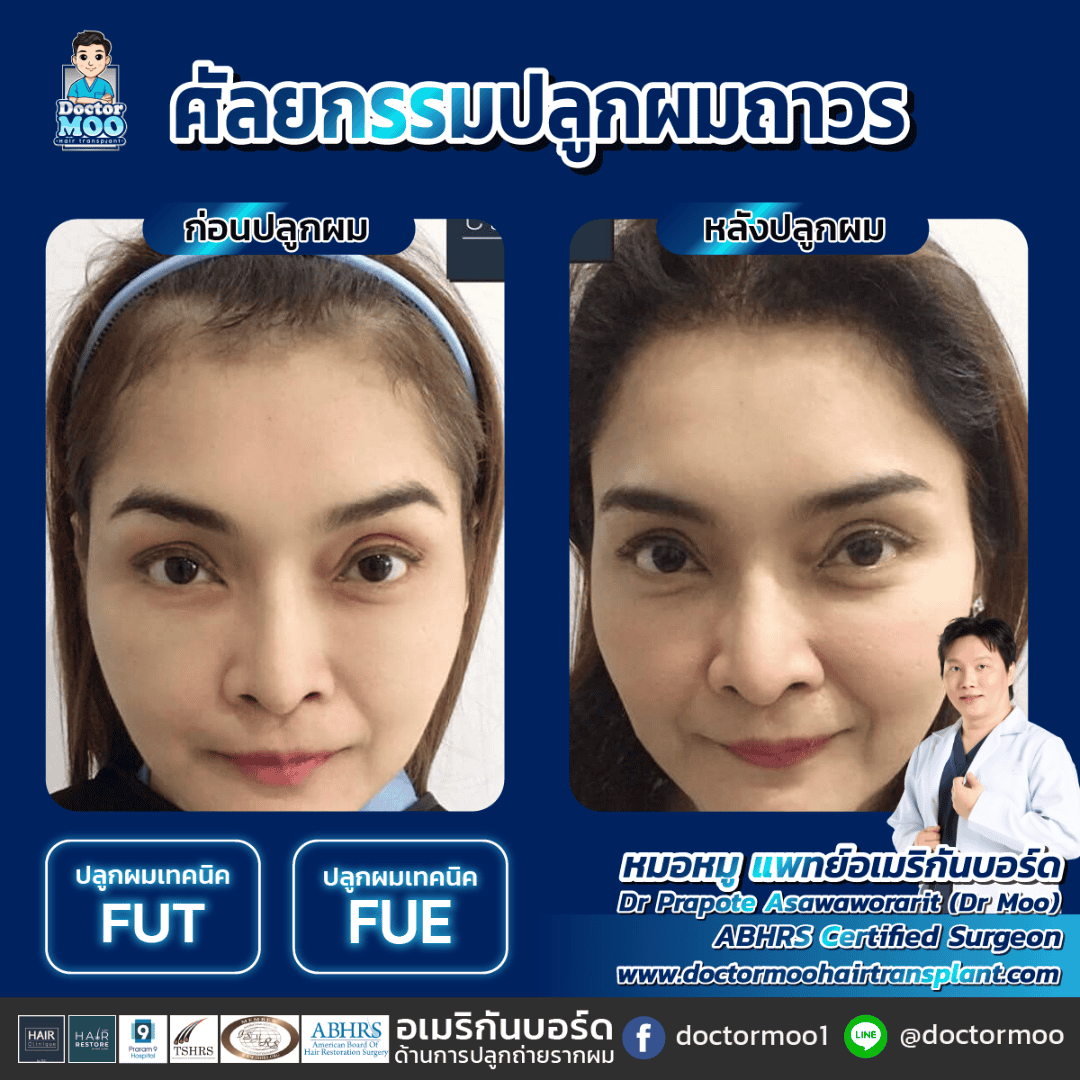 ปลูกผม แก้ปัญหาหน้าผากกว้าง