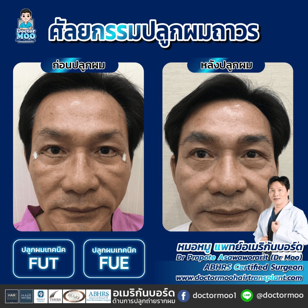 ปลูกผมไม่ขึ้น