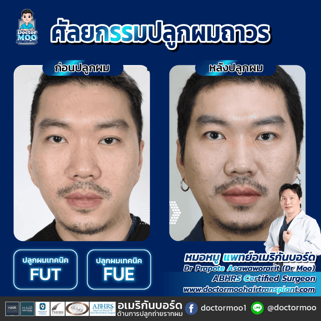 ปลูกผมไม่ต้องโกน