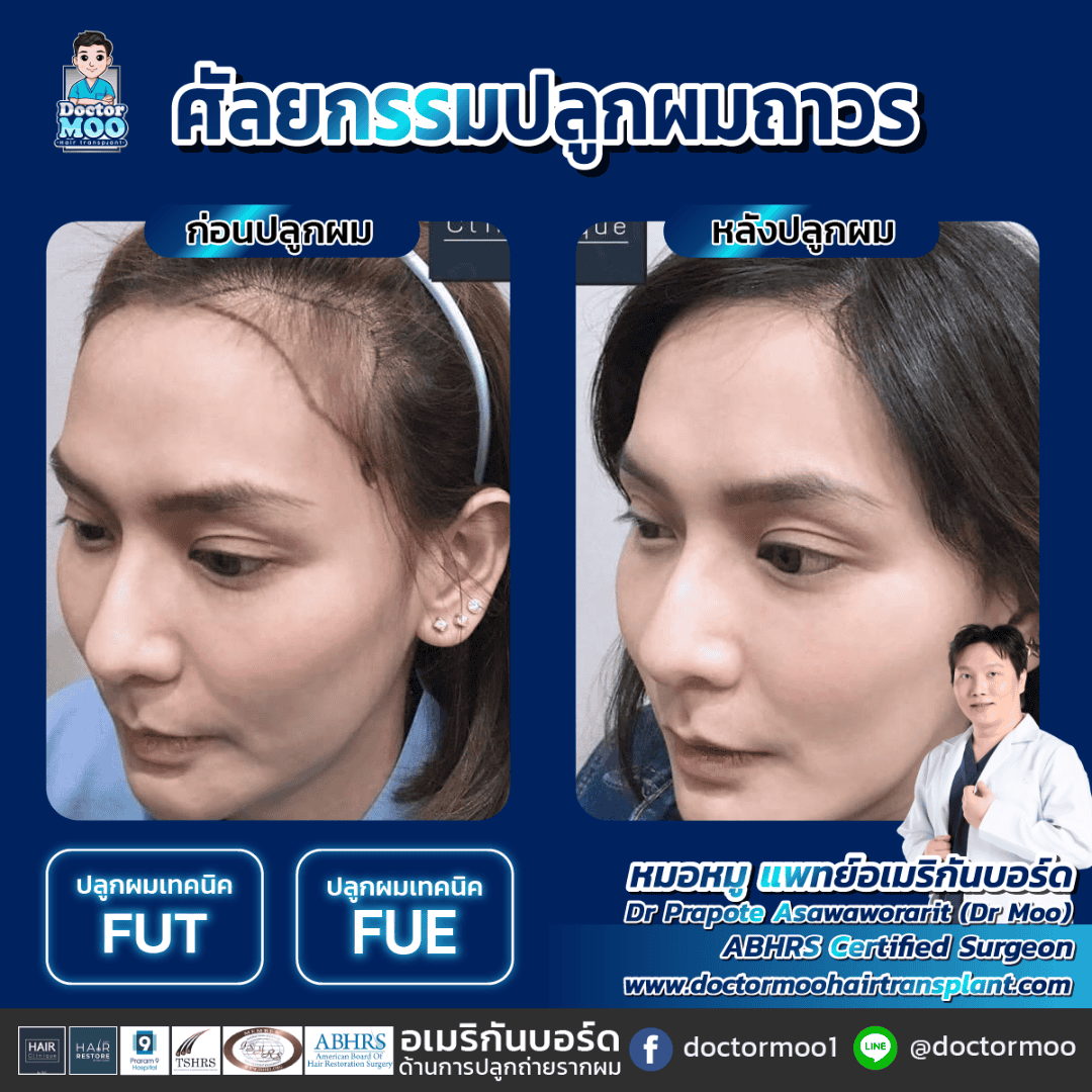 สะเก็ดหลังปลูกผม