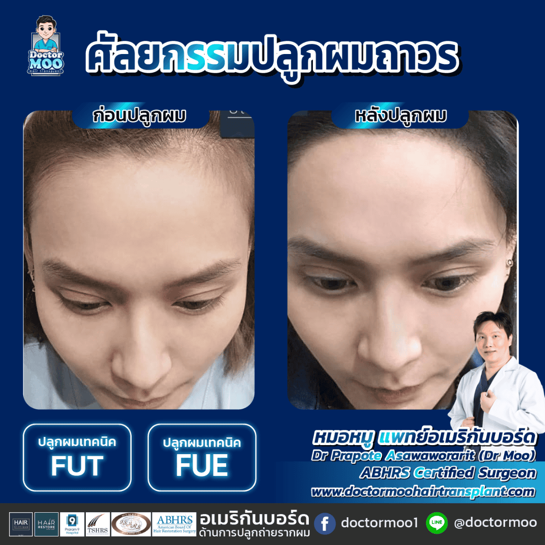 hair transplant คือ