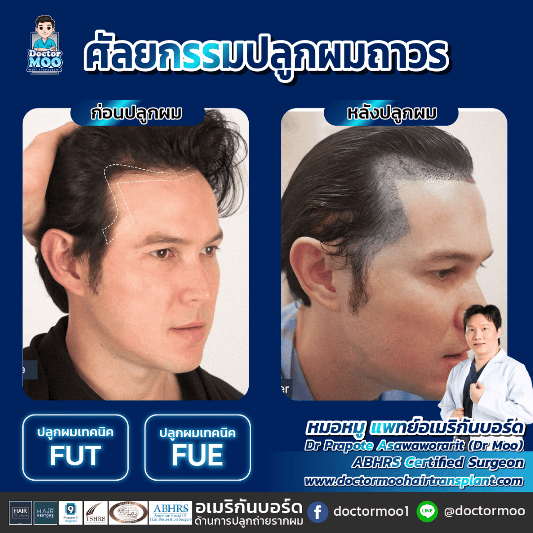 ปลูกผมยาว 