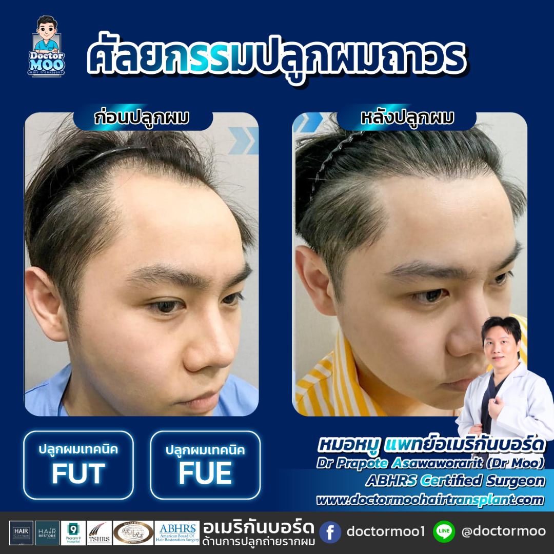 ปลูกผมยาว