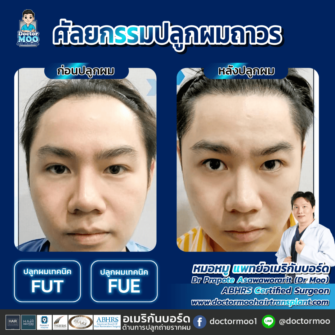 ปลูกผมยาว Long Hair