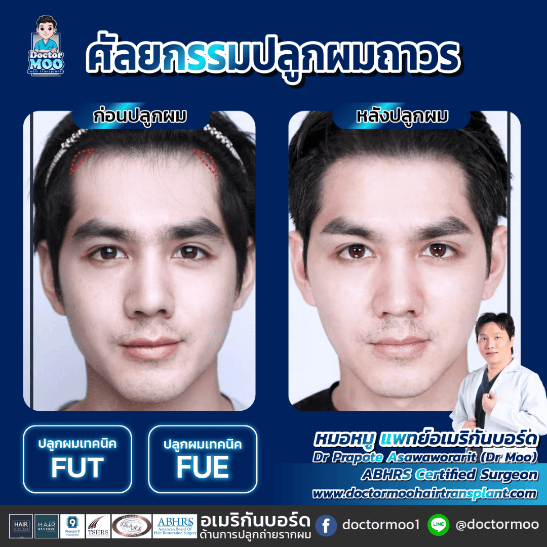 ปลูกผมยาว Long Hair