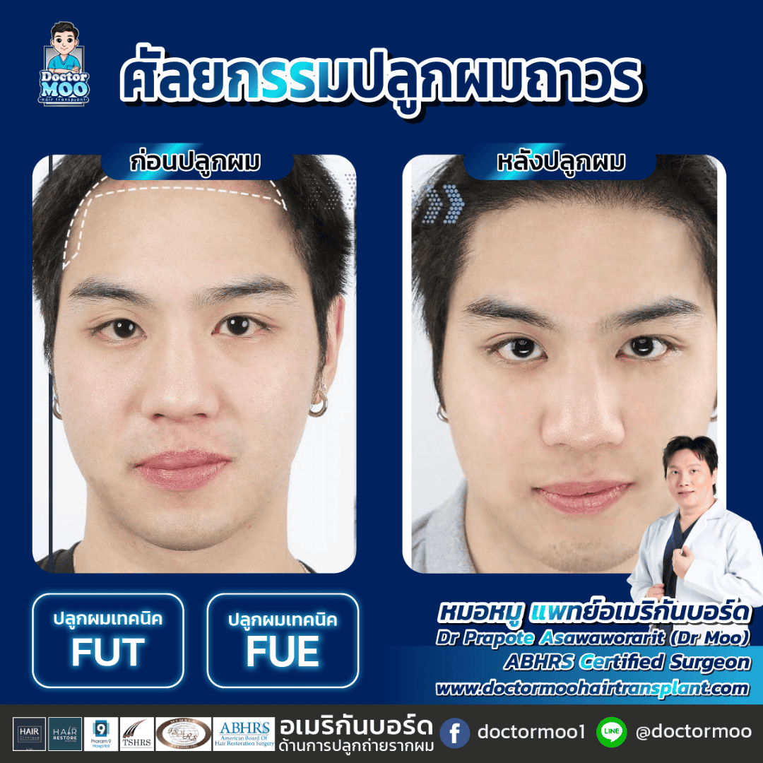 ปลูกผมยาว Long Hair