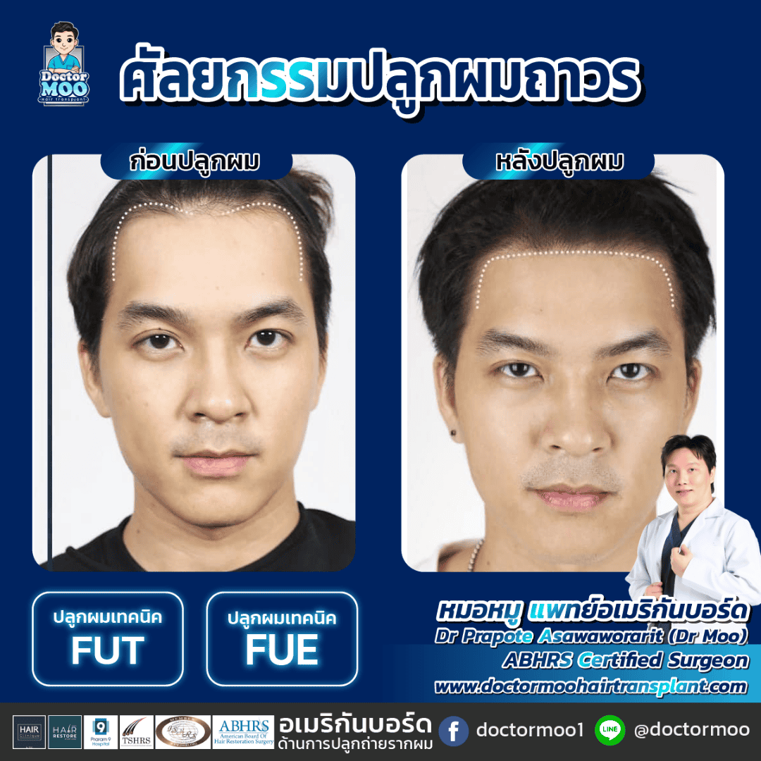 การผ่าตัดปลูกผม