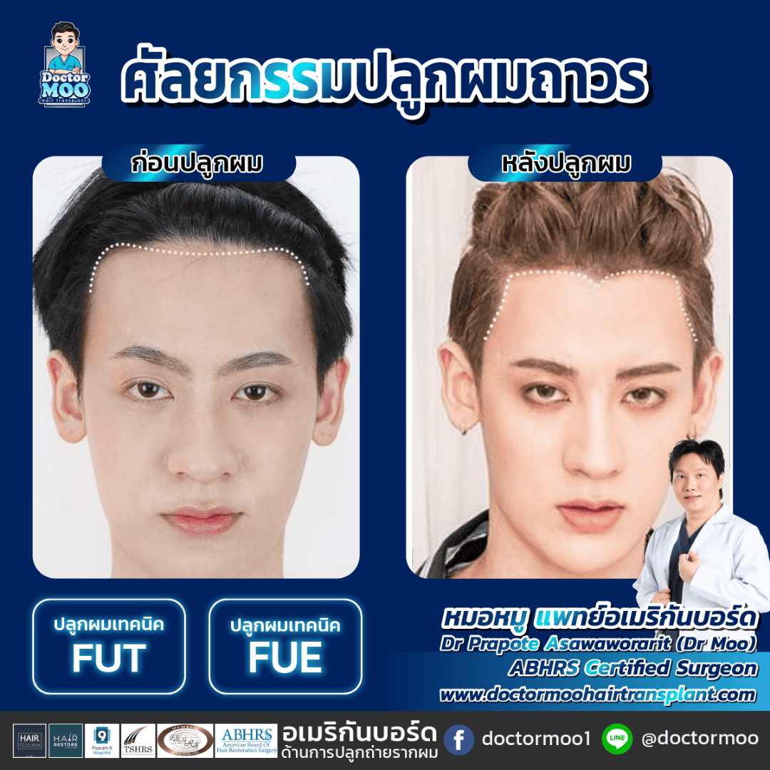 การผ่าตัดปลูกผม