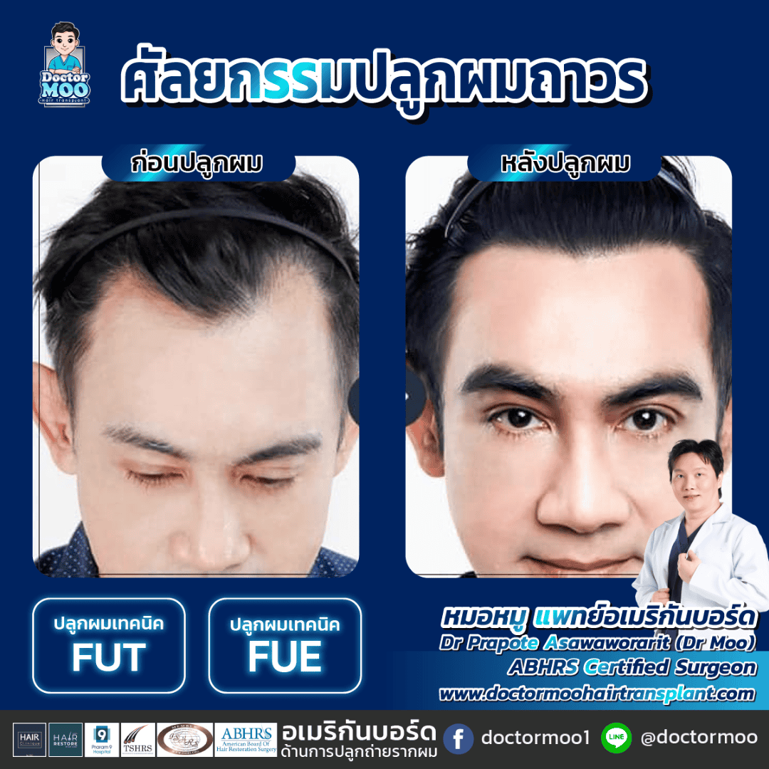 ปลูกผมยาว Long Hair