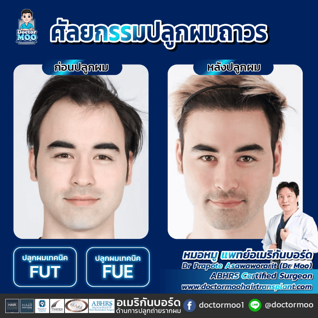 การผ่าตัดปลูกผม