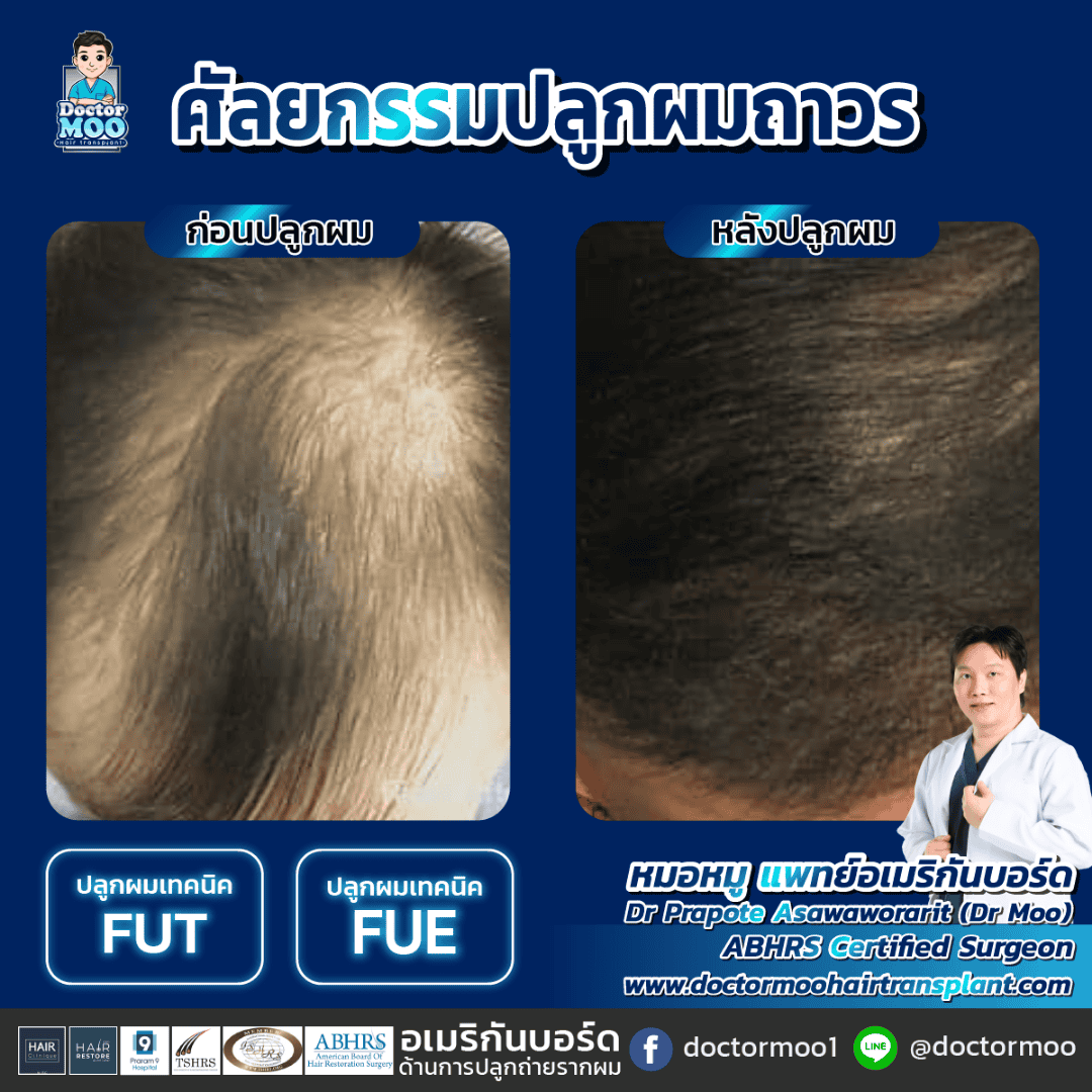 ปลูกผมไม่ขึ้น