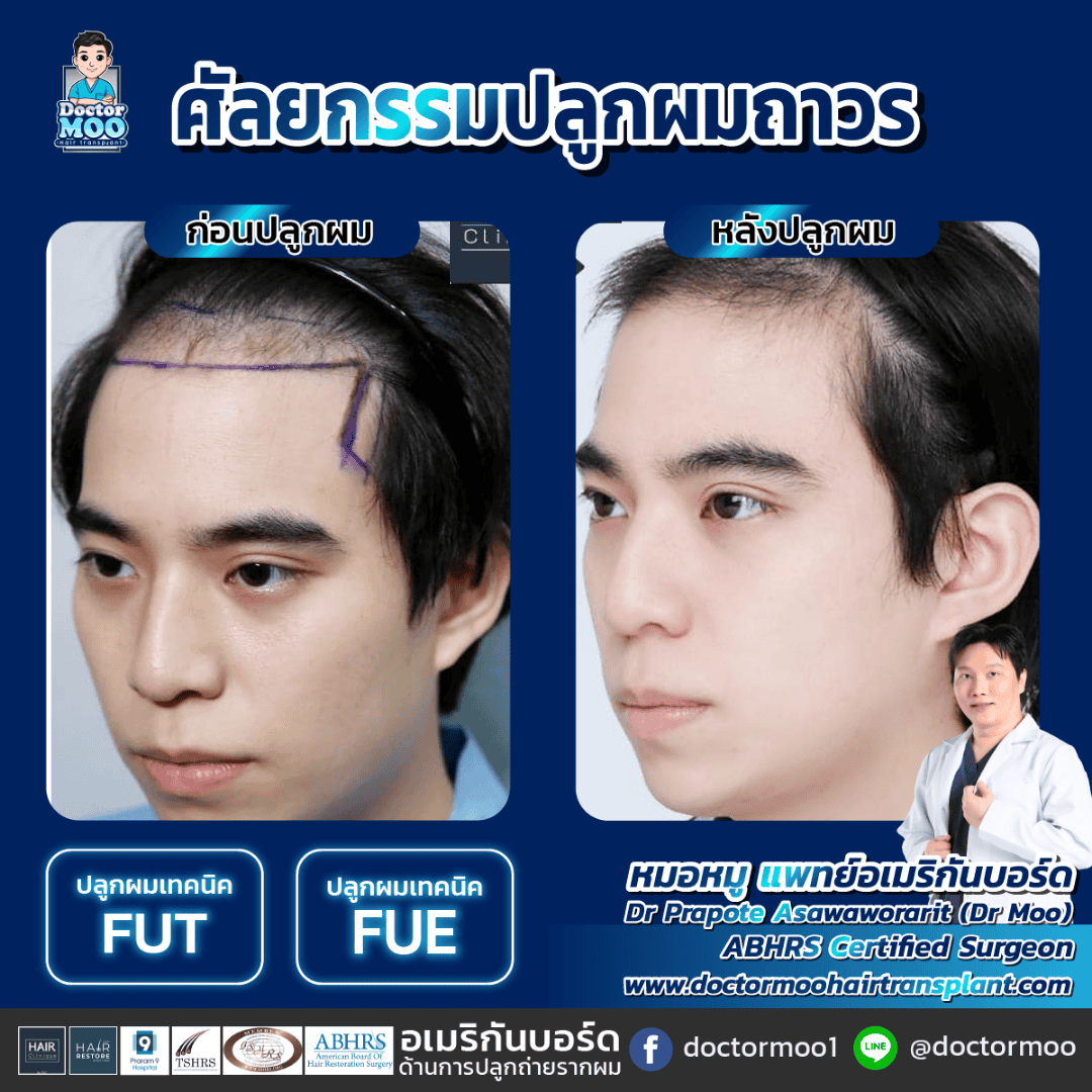 ปลูกผม FUE กับ FUT