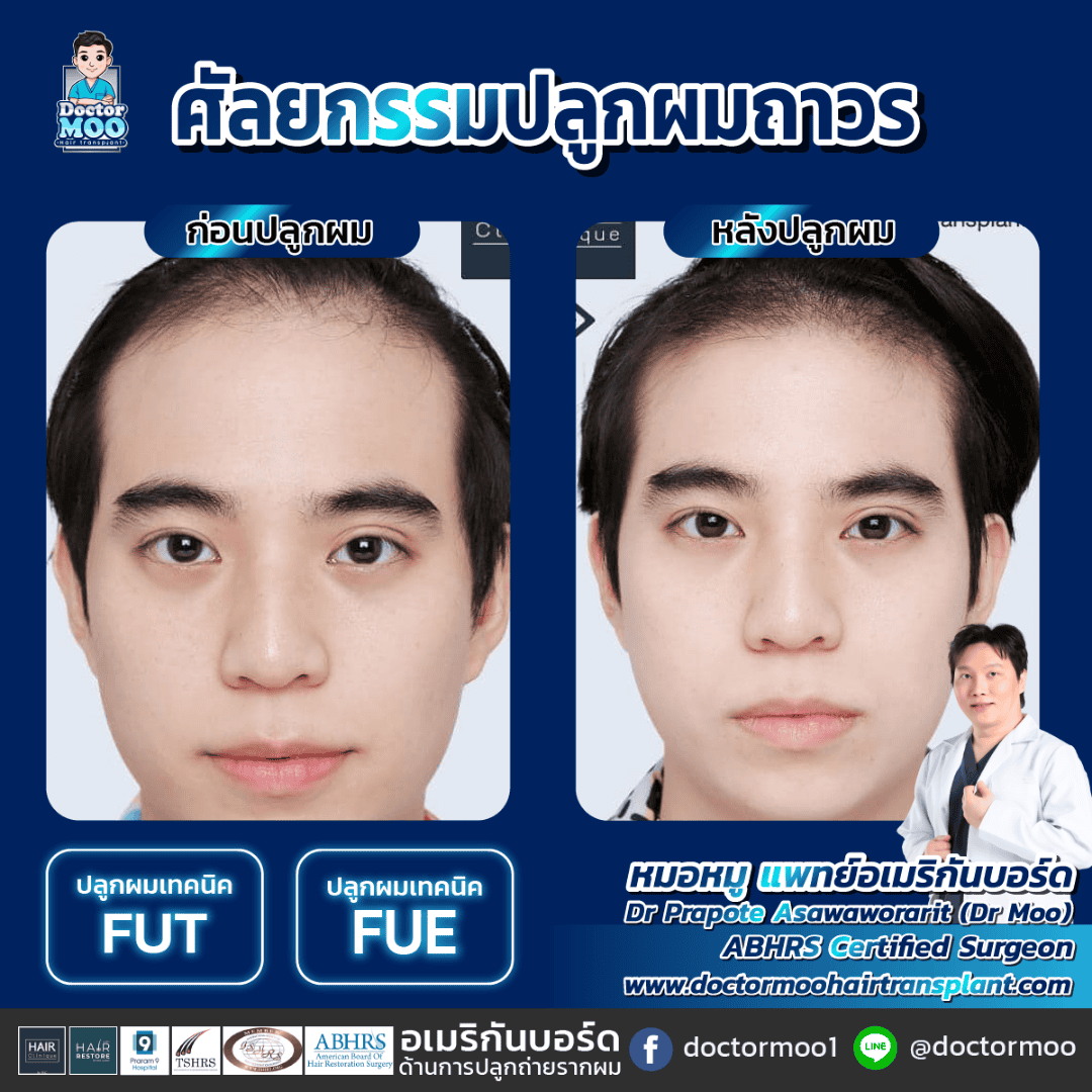 ปลูกผม FUE กับ FUT