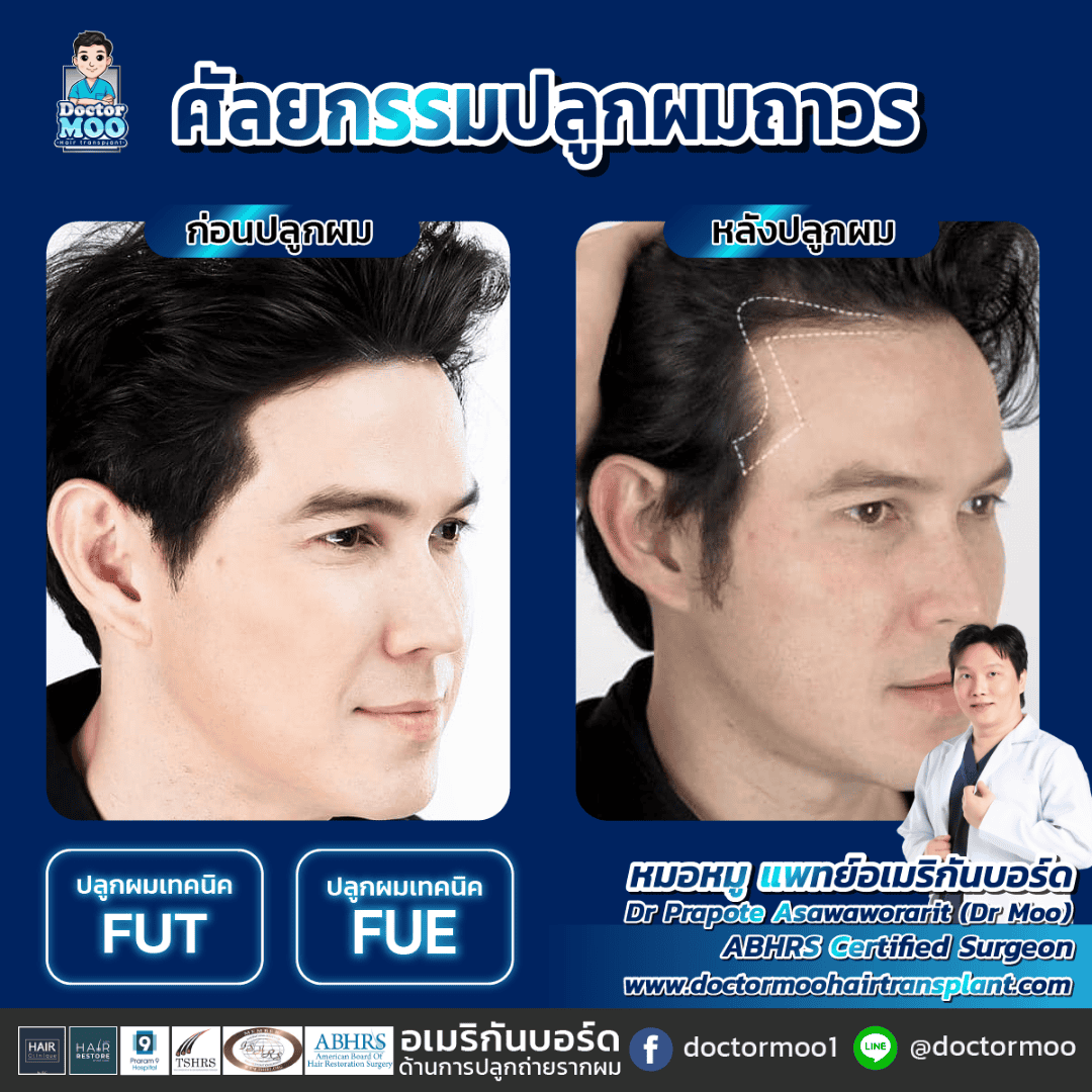 การผ่าตัดปลูกผม