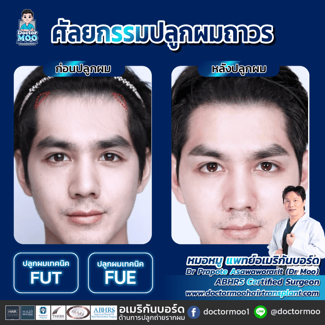 ปลูกผม FUE กับ FUT