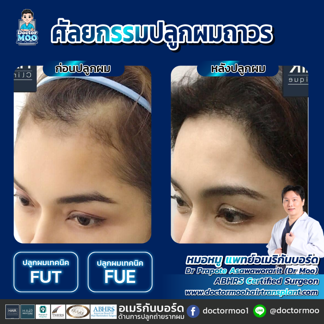 hair transplant คือ
