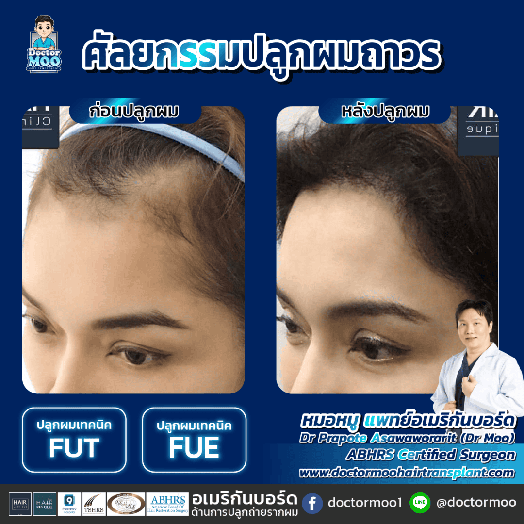 hair transplant คือ