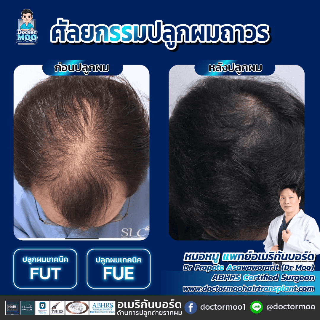 การผ่าตัดปลูกผม