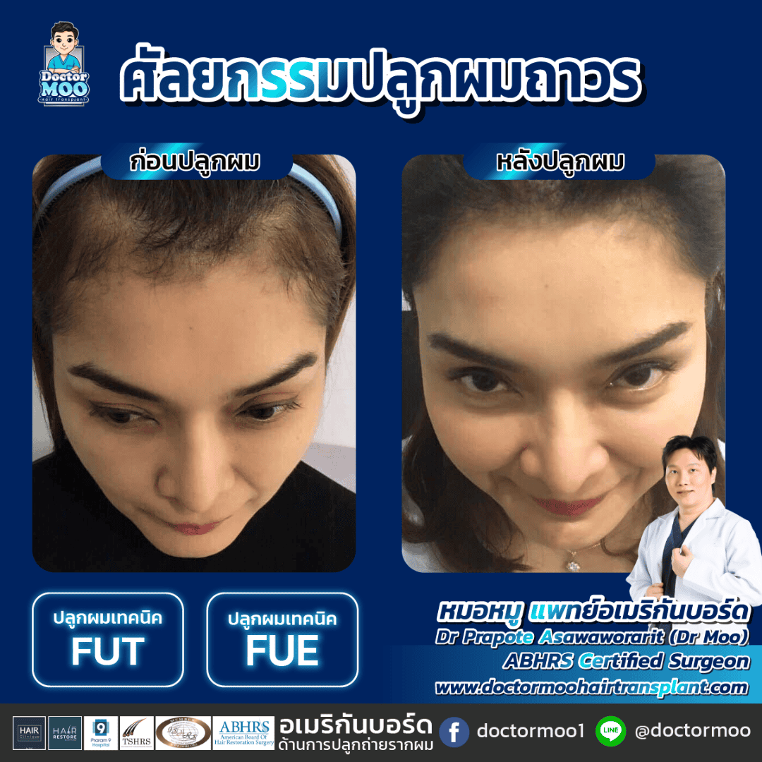 hair transplant คือ