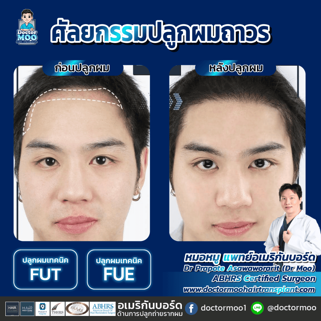 ปลูกผมไม่ขึ้น