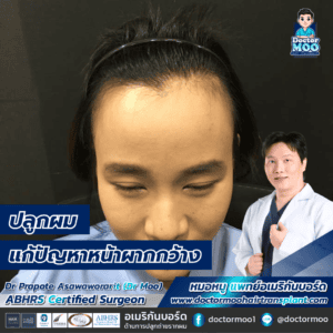 ปลูกผม แก้ปัญหาหน้าผากกว้าง