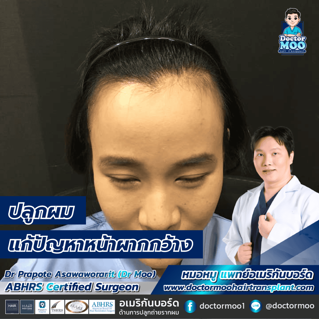 ปลูกผม แก้ปัญหาหน้าผากกว้าง