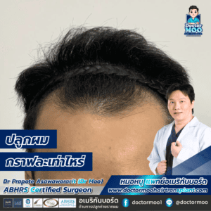 ปลูกผมกราฟละเท่าไหร่