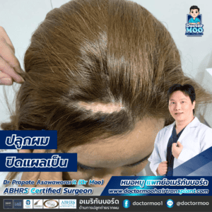 ปลูกผมปิดแผลเป็น