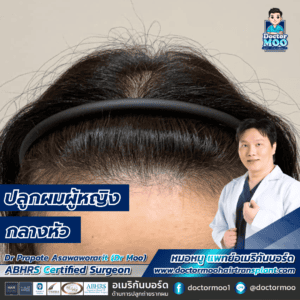 ปลูกผมผู้หญิง กลางหัว