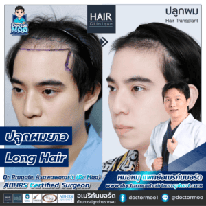 ปลูกผมยาว Long Hair