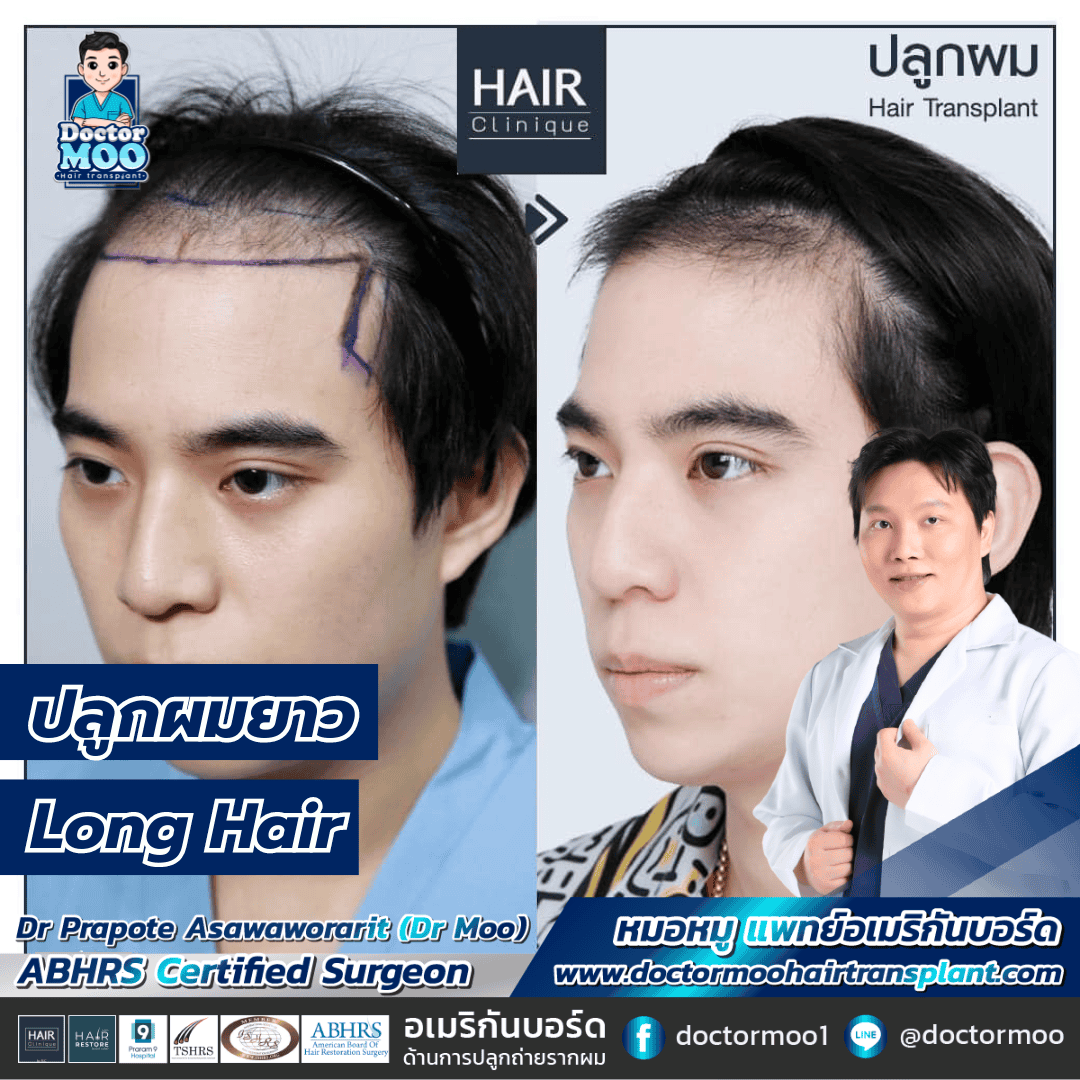 ปลูกผมยาว Long Hair